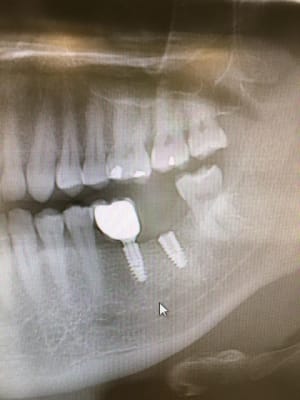 Implant joep0q - Eugenol
