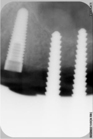 Implant lisse 23 speader c 24 et b 25 atcjph - Eugenol