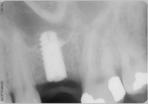 Implant n0zdgx - Eugenol
