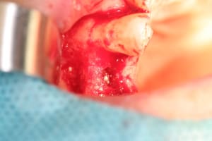 Implantation3 udnupm - Eugenol
