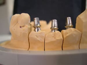 Implants 002 tektnq - Eugenol