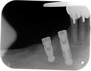 Implants aslo4r - Eugenol