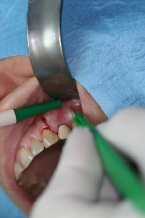 Incision1 r6yqb4 - Eugenol