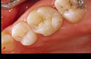 Inlay 4 kfdlmt - Eugenol