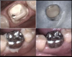 Inlay core    2 xxorvt - Eugenol