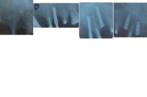 Jour de pose a o0tbuq - Eugenol