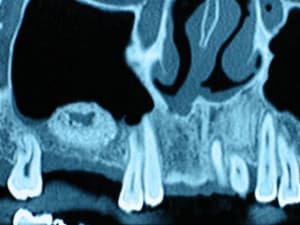 Lacune sinus 1 ndjgas - Eugenol