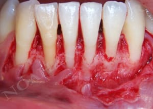 Lambeau mucogingival y1a6cr - Eugenol