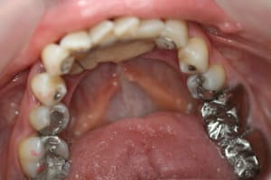 Lingual mxpczq - Eugenol