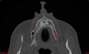 Med axial brysp2 - Eugenol