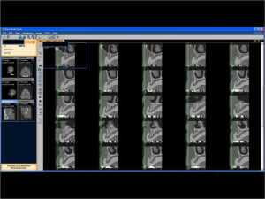 Mise en charge imm diate   expansion osseuse 002 oujl9x - Eugenol