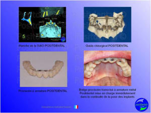 Mise en charge imm diate   expansion osseuse 014 qufflh - Eugenol