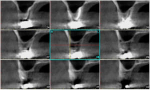 Molaire en vatech  ndhgqk - Eugenol