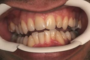 Occlusion b8whue - Eugenol