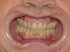 Occlusion cas terminé avec dentosophie f6mhv7 - Eugenol