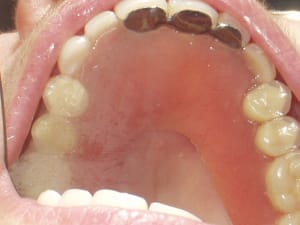 Overdenture  1  g8wj2g - Eugenol