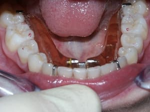 Plaquemand ijfreg - Eugenol