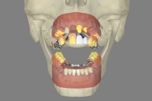 Plaques metal apparente  a015qo - Eugenol