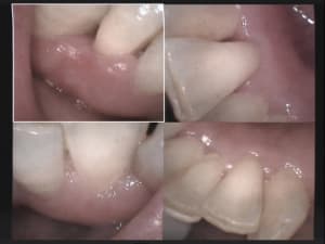 Poche serpengineuse de 10 mm en vestibulaire 32 à 10 jours oagrex - Eugenol