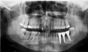 Post dnjhil - Eugenol