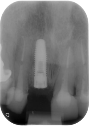 Post op z6rjcp - Eugenol