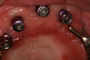 Pr op proth ses sur implants haunt bas 006 dibvtm - Eugenol
