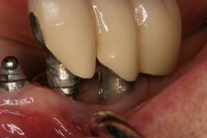 Pr op proth ses sur implants haunt bas 011 slmxoc - Eugenol