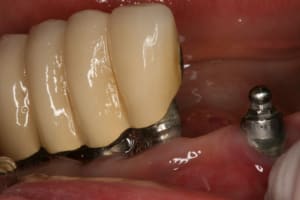 Pr op proth ses sur implants haunt bas 012 mfts0v - Eugenol