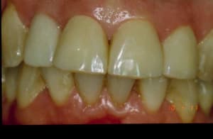 Provisoires xbyji5 - Eugenol