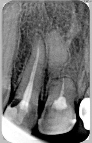 Pseudo arthrose aoo4kt - Eugenol