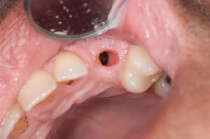 Puit acces trop petit vdk2ey - Eugenol