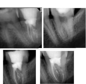 Radio endo xaixb8 - Eugenol