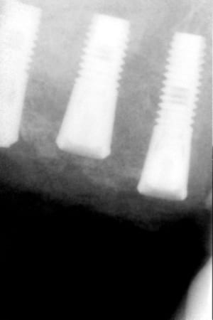 Radio implants j0kbhm - Eugenol