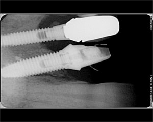 Radio implants la8idn - Eugenol