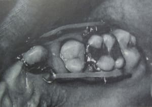 Retraction tqbuhi - Eugenol