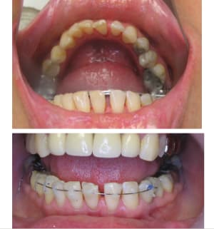 Rotation et diastème mdlhww - Eugenol
