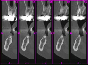 Scan3 reste radiculaire 46 d rlj4te - Eugenol