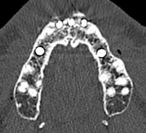 Scanner implant 12 viii mafwvr - Eugenol