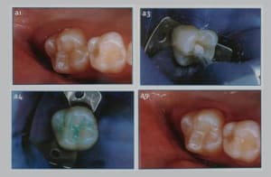 Sealant préventif jmryaq - Eugenol