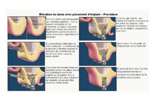 Sinus lift i6pujz - Eugenol