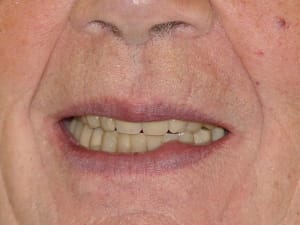 Sourire cas terminé avec dentosophie t49rv7 - Eugenol
