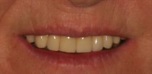 Sourire edvt4z - Eugenol