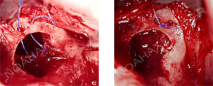 Suture perforation sinus tvtnol - Eugenol
