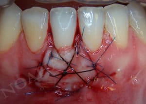 Sutures gnghlo - Eugenol