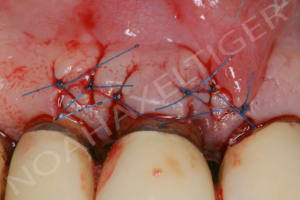 Sutures papillaires vestibulaires zzzita - Eugenol