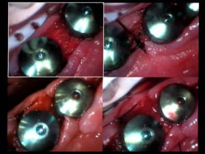 Sutures toujours en cours eyyzyo - Eugenol