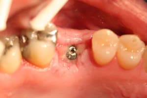 Tête implant z45hyi - Eugenol