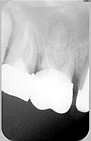 Tentable soqaxc - Eugenol