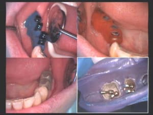 Un cas difficile empreinte définitive bas wamkkk - Eugenol