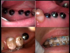 Un cas difficile ortho en cours après réouverture 3 jmn5vb - Eugenol